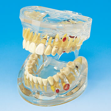 Transparentn model onemocnn zub