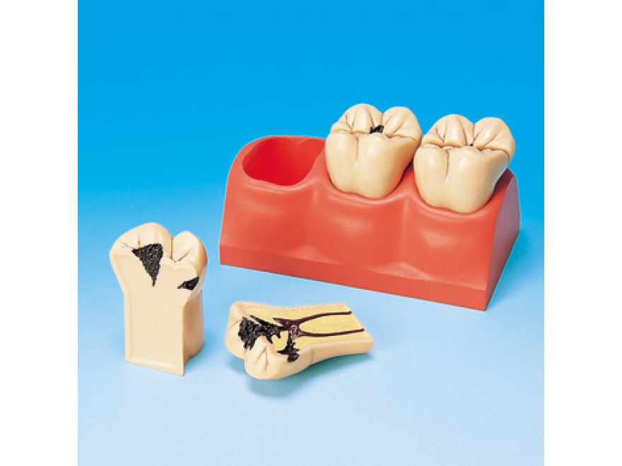 4 zvten model zubnch kaz