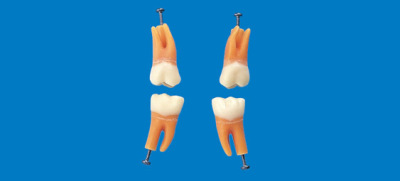 Model zubu s rozvetveným koreňom (zub č. 46)