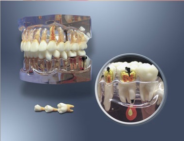 MDO-64 - Zvten model pro zubn hygienu a vvoj zubnho kazu