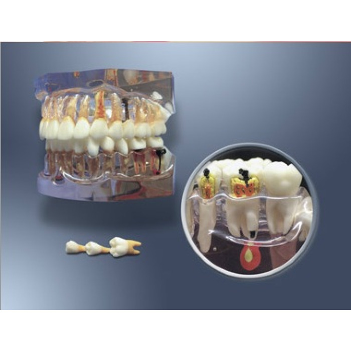 MDO-64 - Zvten model pro zubn hygienu a vvoj zubnho kazu