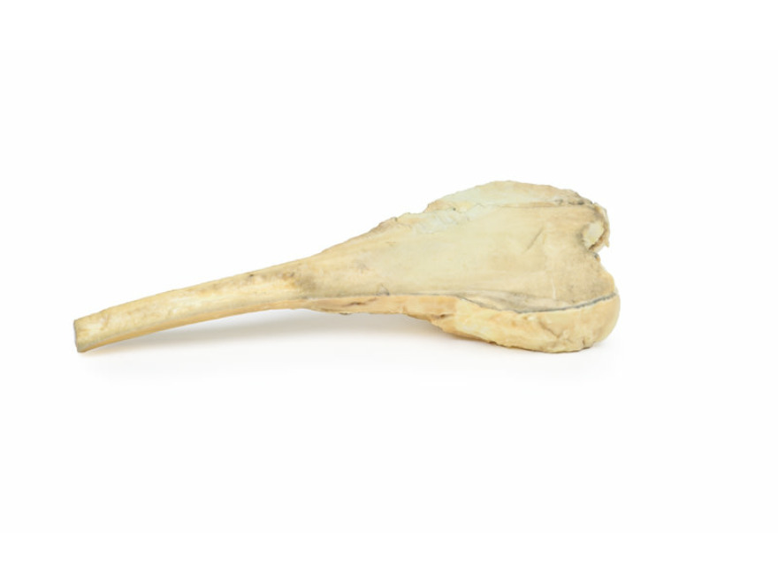 MP2115  -  Osteosarkom stehenn kosti
